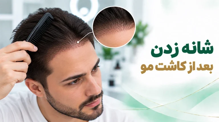 شانه زدن بعد از کاشت مو