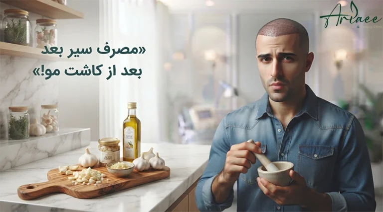 مصرف سیر بعد از کاشت مو!