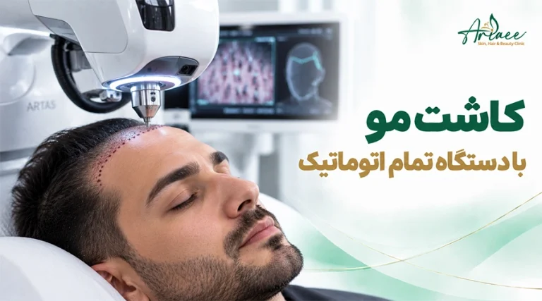 کاشت مو با دستگاه تمام اتوماتیک