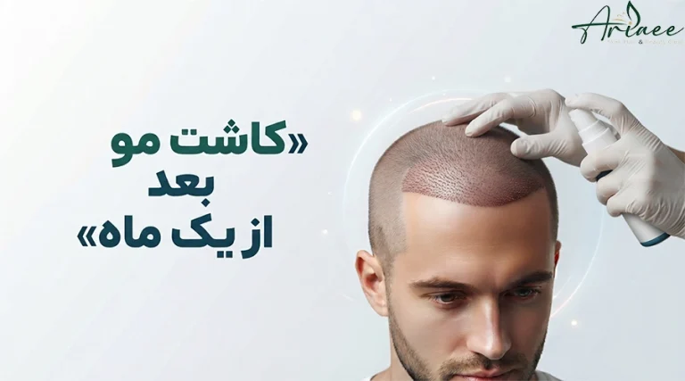 کاشت مو بعد از یک ماه