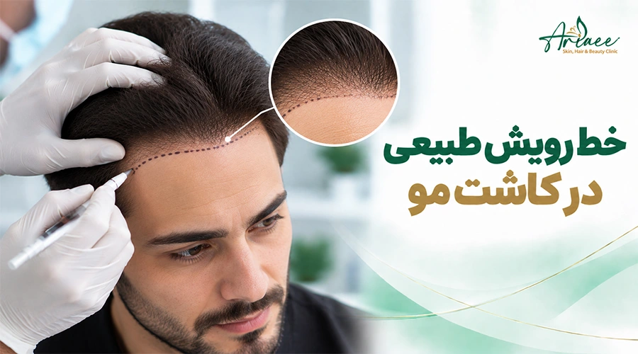 خط رویش طبیعی در کاشت مو