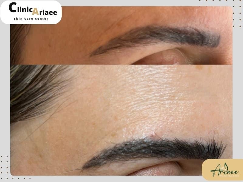 روند انجام کاشت ابرو