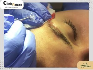 آیا کاشت ابرو درد دارد؟