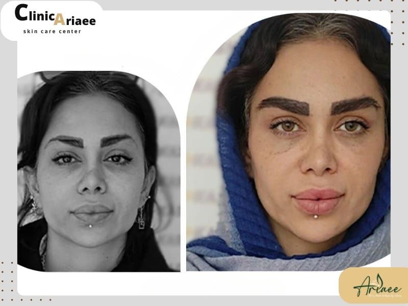 تجربه مراجعین از درد کاشت ابرو