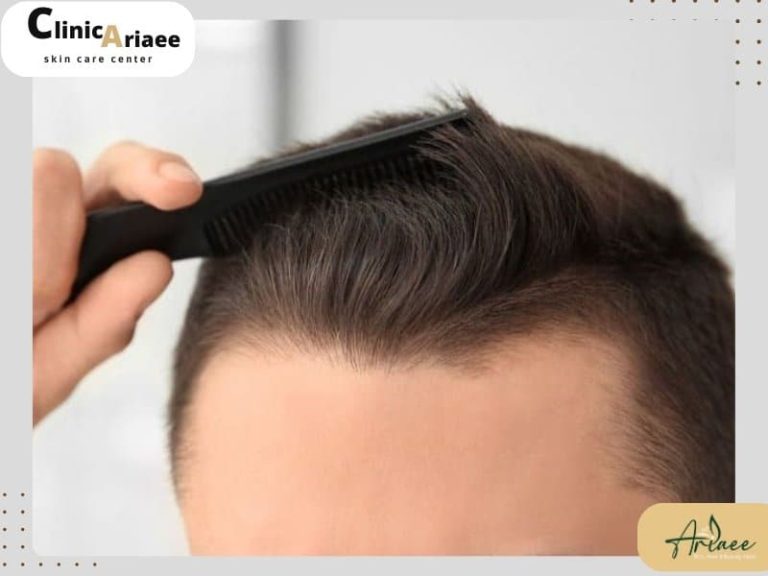 بهترین جایگزین برای کله پاچه بعد از کاشت مو