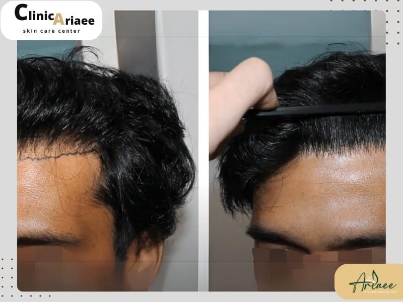 نکاتی مهم طراحی خط رویش مو