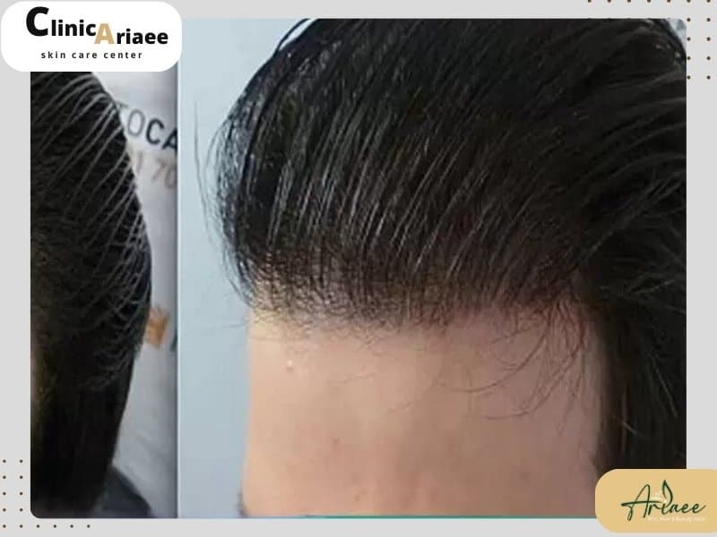 تفاوت خط رویش عروسکی و طبیعی