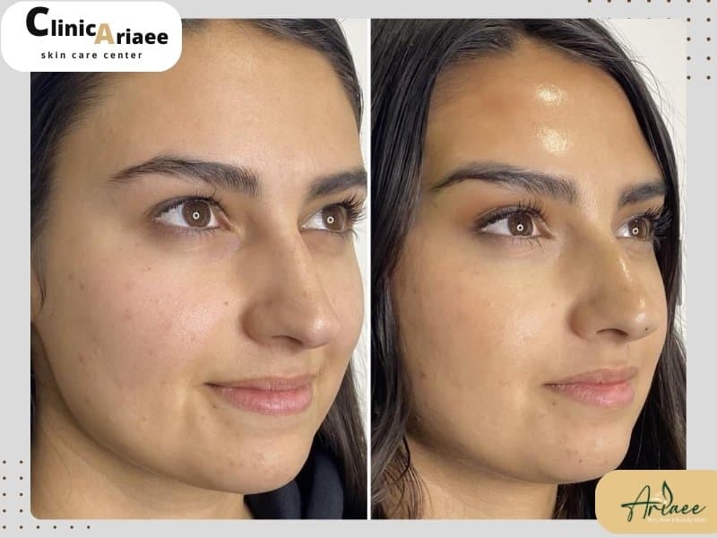 مراقبت های بعد از لیفت ابرو با نخ: