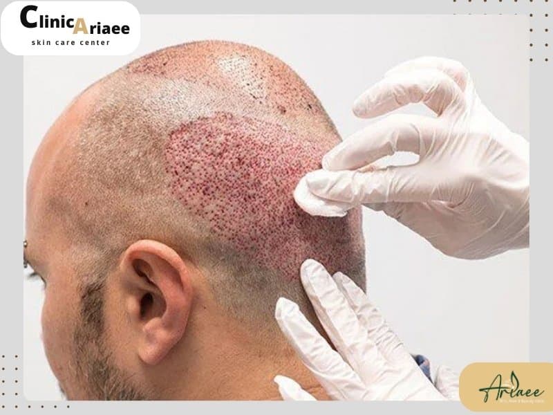 ترمیم بانک مو پس از کاشت