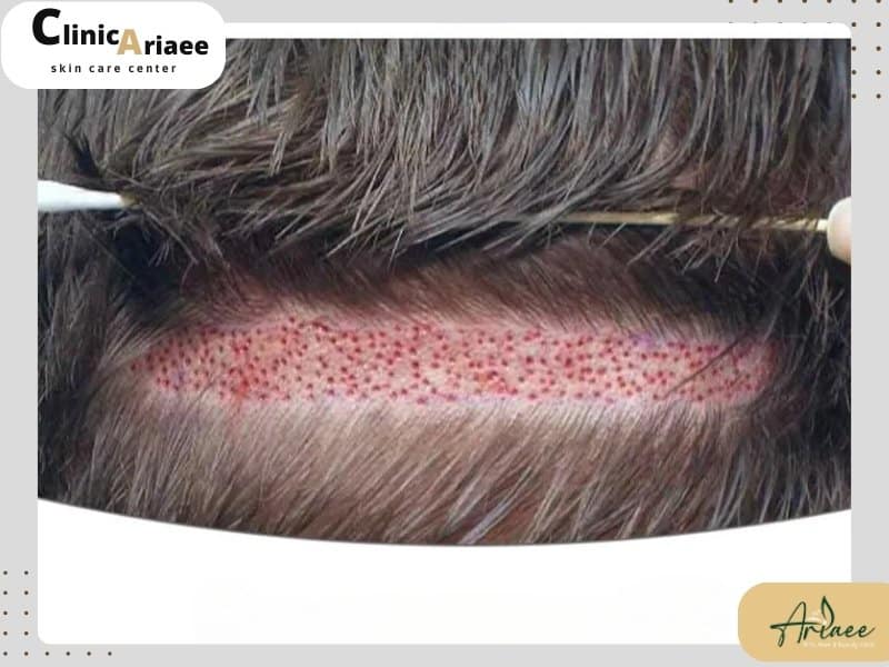 بانک مو چیست و تاثیر آن در این نوع کاشت مو چگونه است؟