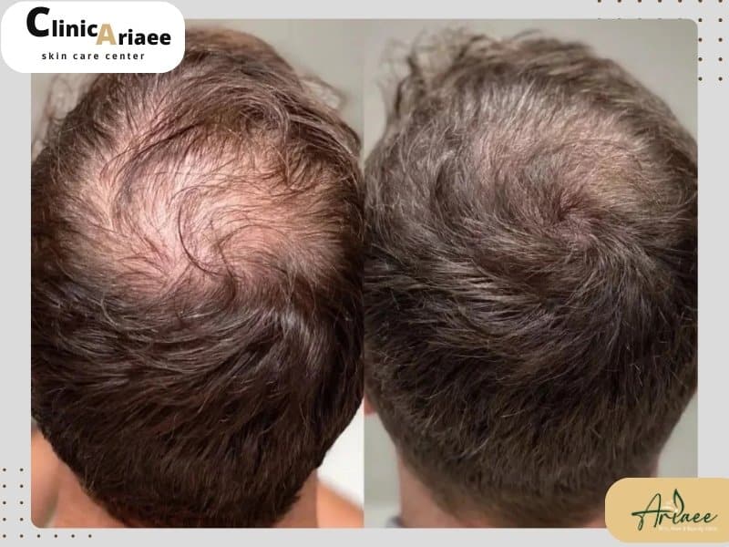 نکات مهم تاثیر ژنتیک در کاشت مو