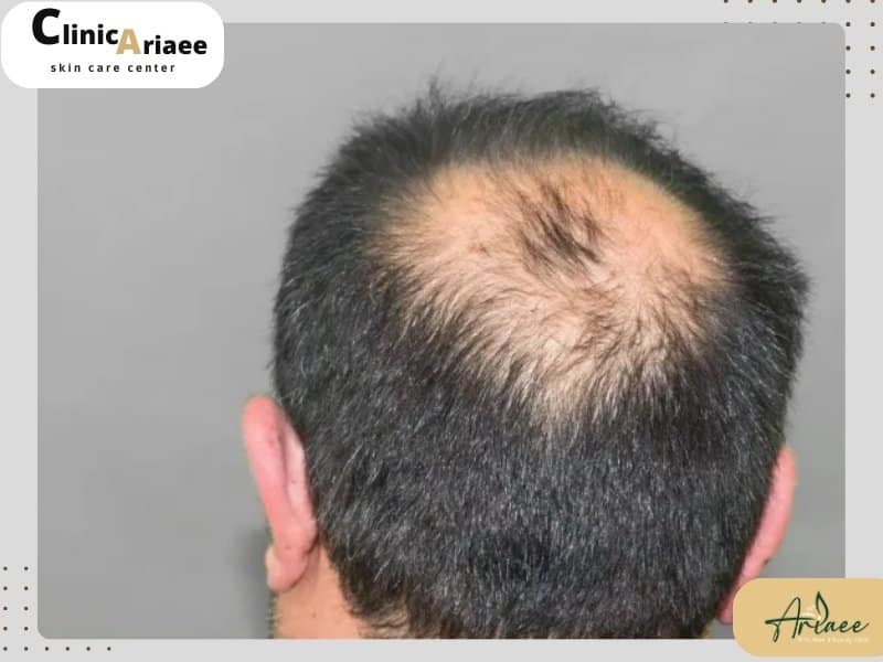 شرایط لازم جهت کاشت مو در ناحیه ورتکس