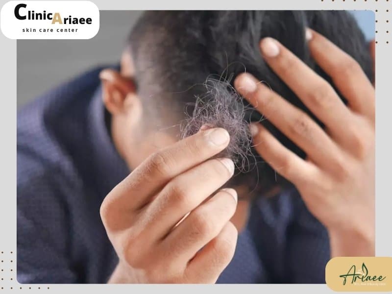 عوامل دیگر موثر بر ریزش مو
