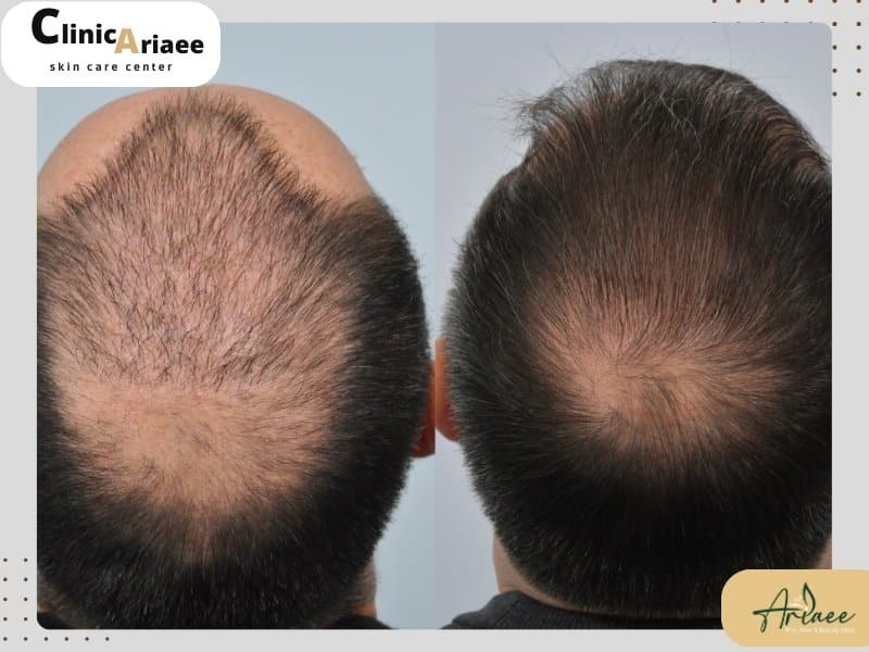 چه افرادی نباید مو بکارند؟