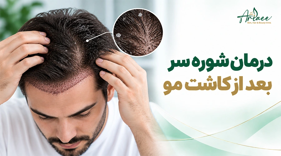درمان شوره سر بعد از کاشت مو