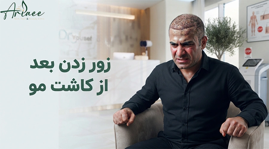 زور زدن بعد از کاشت مو