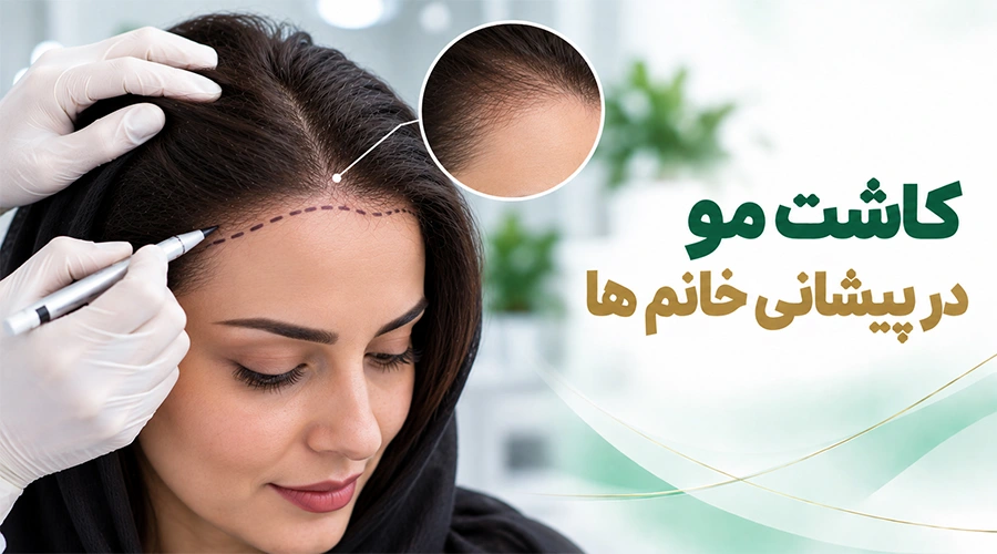 کاشت مو در پیشانی خانم ها