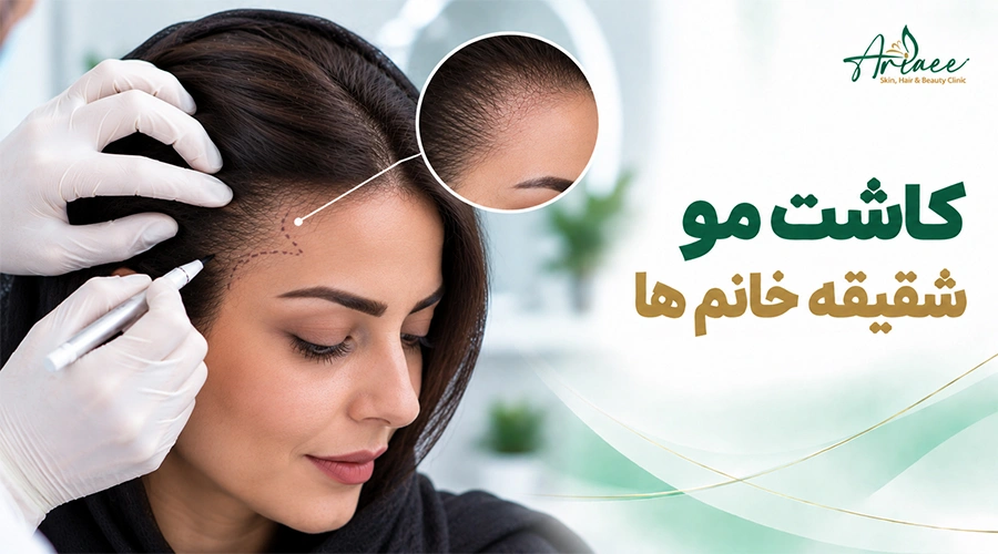 کاشت مو شقیقه خانم ها