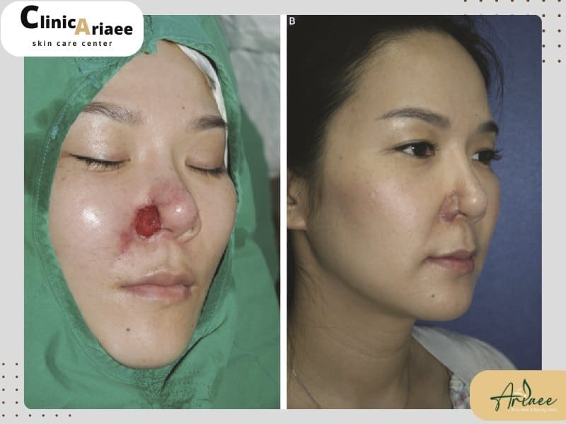 مراجعه به پزشک برای نکروز پس از تزریق ژل