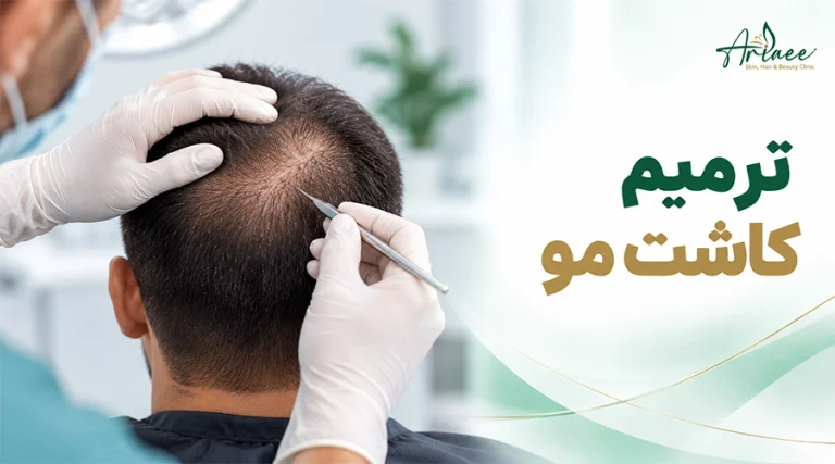 ترمیم کاشت مو