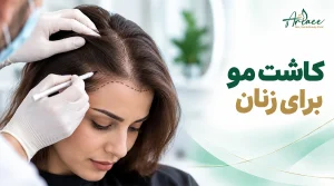 کاشت مو برای زنان