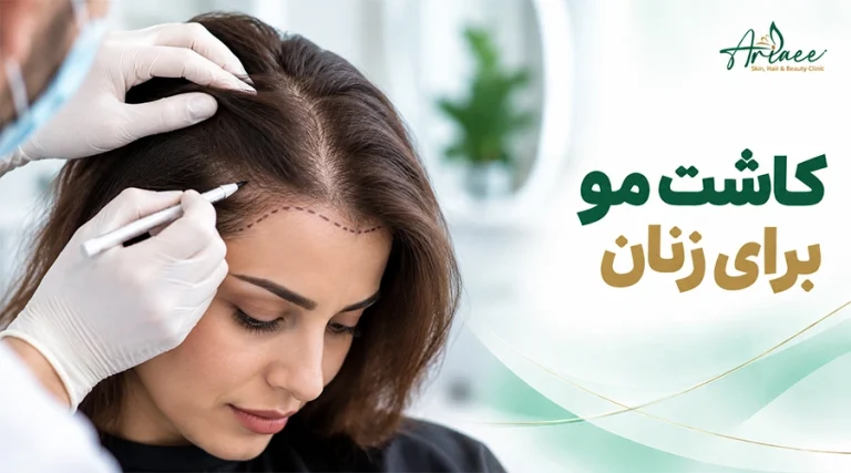 کاشت مو برای زنان