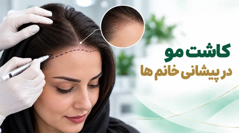 کاشت مو در پیشانی خانم ها