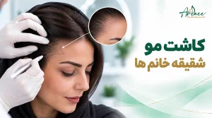 کاشت مو شقیقه خانم ها
