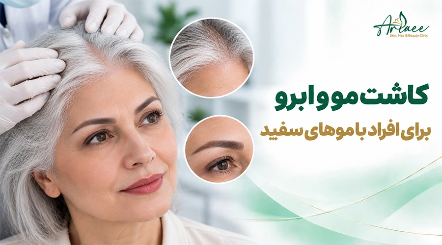 کاشت مو و ابرو برای افراد با موهای سفید