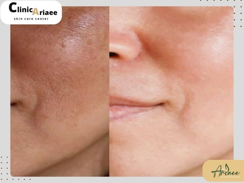 توصیههایی برای کوچک کردن منافذ پوست