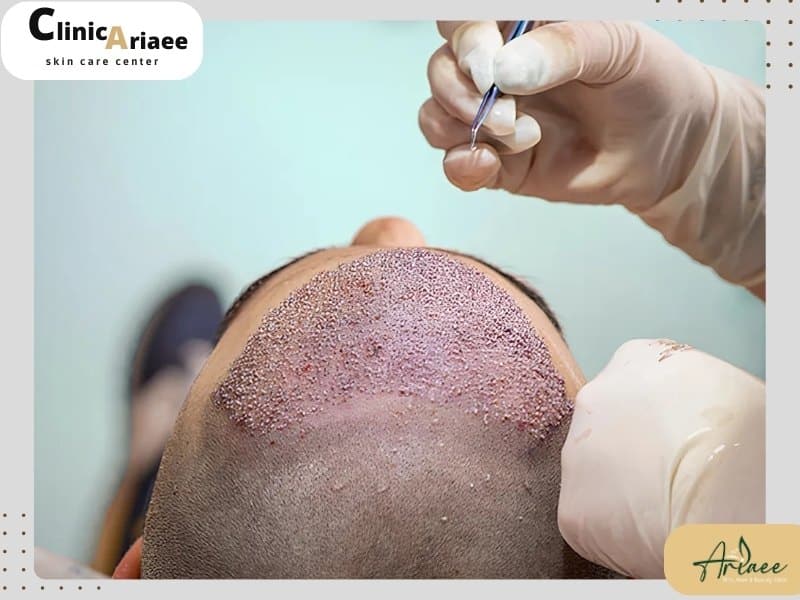 نکات کلیدی درباره کاشت موی یک روزه