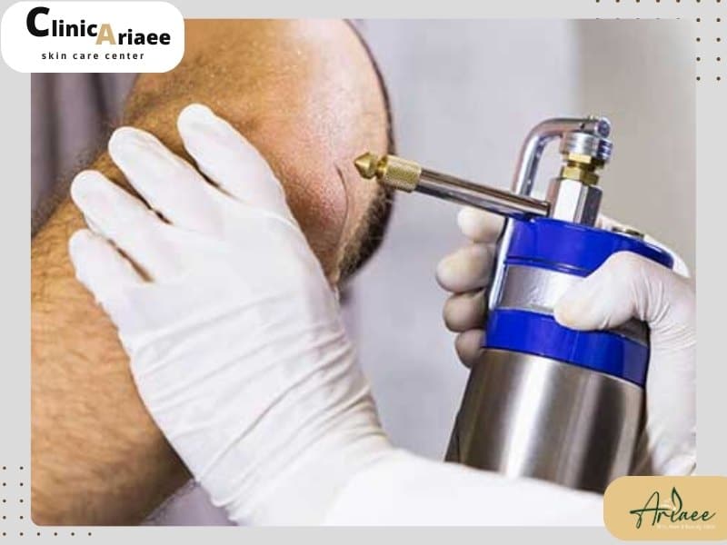 کرایوتراپی با نیتروژن مایع