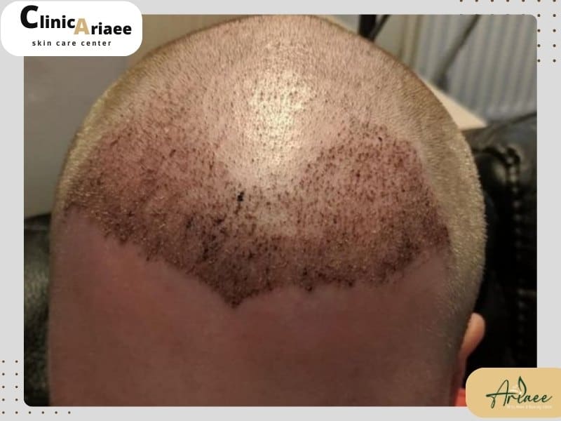 مزایا و معایب روشهای یک روزه و چندروزه