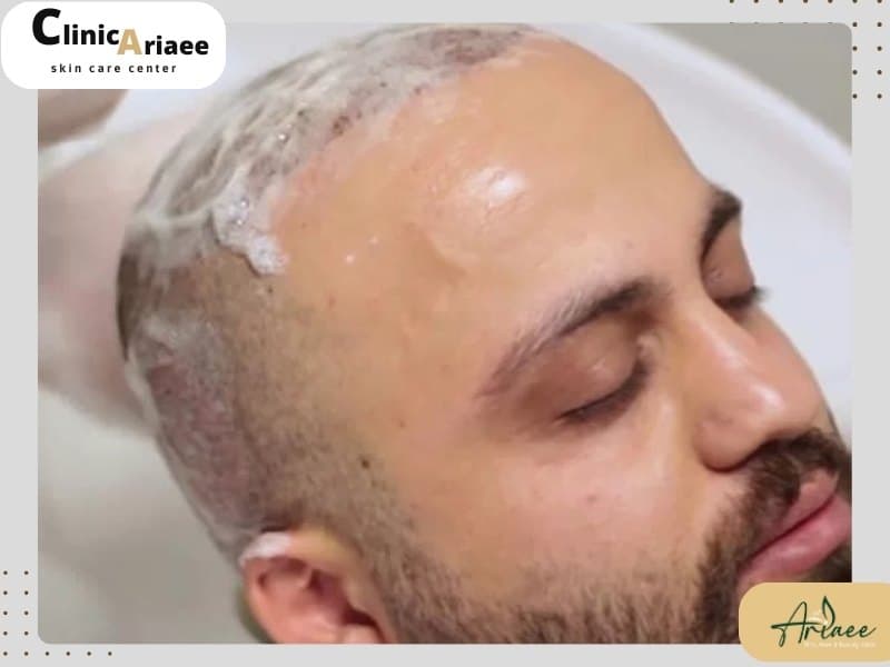 انواع شامپوهای مناسب برای کاشت مو