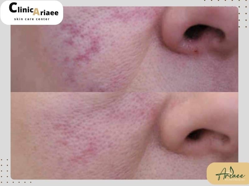 ضایعات عروقى با شیوع بسیار کم