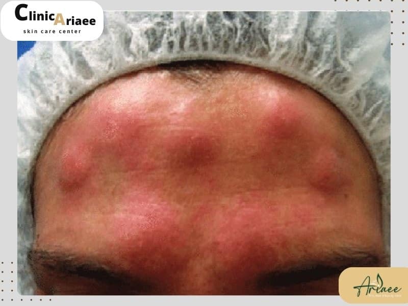 علائم و نشانه های حساسیت به بوتاکس