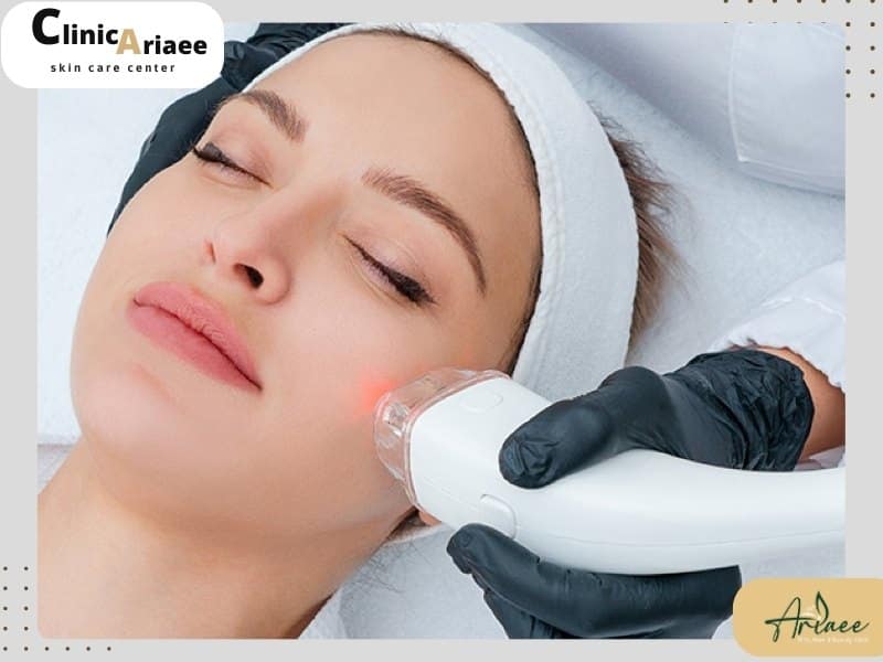 مراقبتهای پیش از انجام لیزر اسکارلت