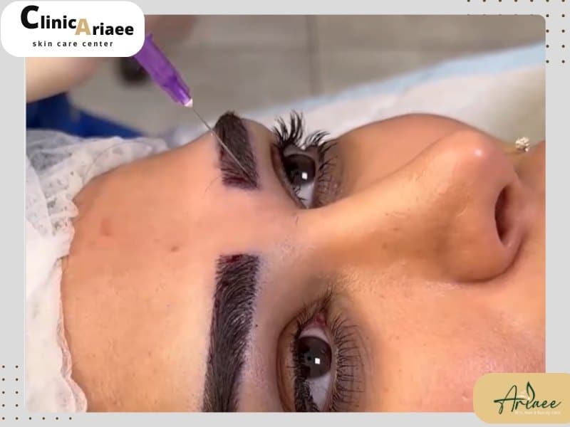 مراحل کاشت ابرو بدون جراحی با نیدل بنفش