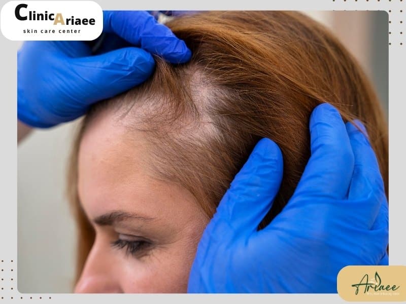 علائم ریزش مو چیست؟