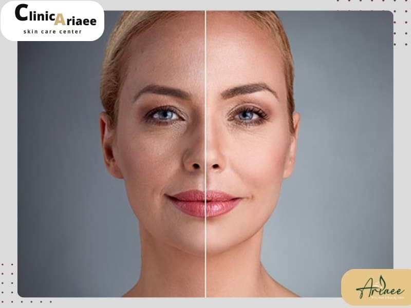 تزریق چربی برای کانتورینگ کدام قسمت های صورت بکار می رود؟