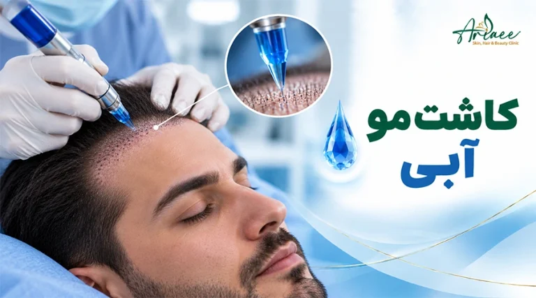 کاشت مو آبی