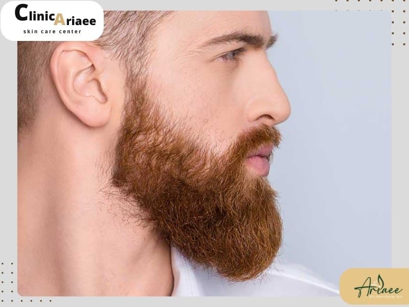 سوالات متداول درباره کاشت ریش و سبیل (FAQ)