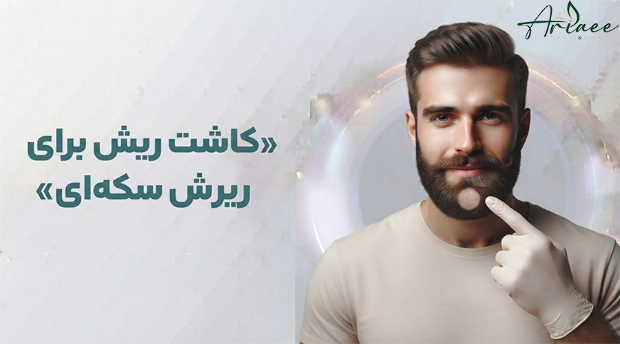 کاشت ریش برای ریزش سکه_ای