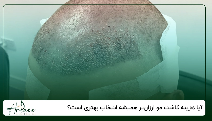 آیا هزینه کاشت مو ارزان_تر همیشه انتخاب بهتری است؟