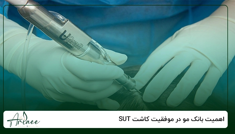 اهمیت بانک مو در موفقیت کاشت SUT