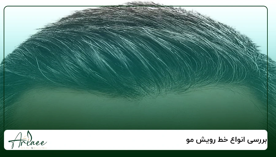 بررسی انواع خط رویش مو