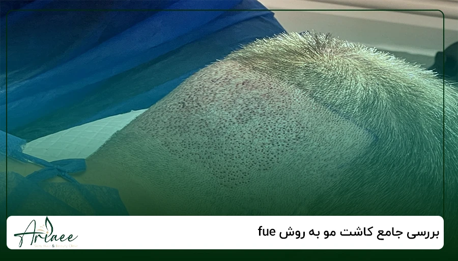 بررسی جامع کاشت مو به روش fue