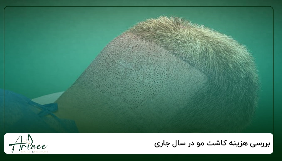 بررسی هزینه کاشت مو در سال جاری