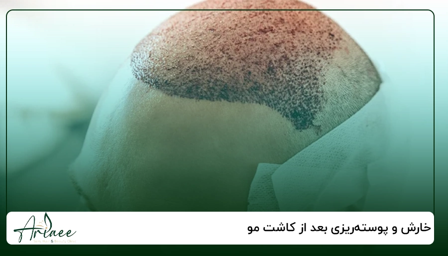 خارش و پوسته_ریزی بعد از کاشت مو