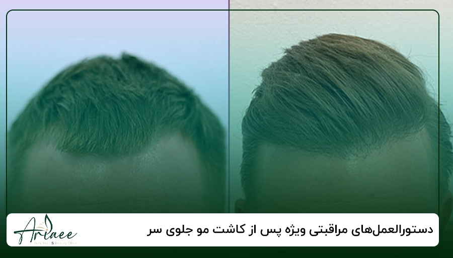 دستورالعمل_های مراقبتی ویژه پس از کاشت مو جلوی سر